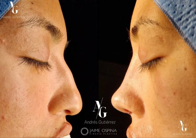 Rinoplastia Ultrasónica Estructural + septoturbinoplastia ♀️, resultado inmediato postQx.
°
°
Nariz étnica. Pequeña giba dorsal, punta ptósica y poco definida, a pesar del grosor de la piel logramos una buena definición.
°
°
Equipo quirúrgico:
@drjaimeospina CPL
@andresgutierrez.dr ORL
°
°
#rinoplastia #rinoplastiaultrasonica #ultrasonicrhinoplasty
#rhinoplasty #cirugiadenariz #nosejob #cirugiaplasticafacial #facialplasticsurgery #resultadosnaturales #antesydespues #beforeandafter #nosesurgery #rhinoplastybeforeandafter #rhinoplastyspecialist #facialplasticsurgery #topdoc #aesthetic #rinoplasti #estetik #estetikburun #burunestitigi #nose #nasen #newnose #cirugiaplastica #chirurgiaplastica #chirurgieplastique #rhinoplastie #rinoplastica