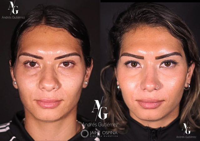 Rinoplastia Ultrasónica Estructural + Radiofrecuencia de cornetes inferiores + Septoplastia, resultado a los 8 meses.
°
°
Equipo quirúrgico: #rhinoteam 🤜🏽🤛🏼
@drjaimeospina CPL
@andresgutierrez.dr ORL
°
°
#rinoplastia #rinoplastiaultrasonica #ultrasonicrhinoplasty
#rhinoplasty #cirugiadenariz #nosejob #cirugiaplasticafacial #facialplasticsurgery #resultadosnaturales #antesydespues #beforeandafter #nosesurgery #rhinoplastybeforeandafter #rhinoplastyspecialist #facialplasticsurgery #topdoc #aesthetic #rinoplasti #estetik #estetikburun #burunestitigi #nose #nasen #newnose #cirugiaplastica #chirurgiaplastica #chirurgieplastique #rhinoplastie #rinoplastica