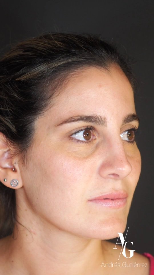 Resultado a los 3 meses de Rinoplastia Ultrasónica Estructural ♀️
Especial agradecimiento a mi paciente por permitirme compartir este bonito resultado! 🙏🏼
Equipo quirúrgico: #rhinoteam 🤜🏽🤛🏼
@drjaimeospina CPL
@andresgutierrez.dr ORL
#rinoplastia #rinoplastiaultrasonica #ultrasonicrhinoplasty
#rhinoplasty #cirugiadenariz #nosejob #cirugiaplasticafacial #facialplasticsurgery #resultadosnaturales #antesydespues #beforeandafter #nosesurgery #rhinoplastybeforeandafter #rhinoplastyspecialist #facialplasticsurgery #topdoc #aesthetic #rinoplasti #estetik #estetikburun #burunestitigi #nose #nasen #newnose #cirugiaplastica #chirurgiaplastica #chirurgieplastique #rhinoplastie #rinoplastica