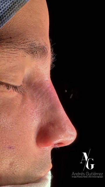 Resultado inmediato de Rinoplastia Ultrasónica Estructural primaria. 👨🏻 👃🏼
.
Equipo quirúrgico - Rhinodocs:
@drjaimeospina
@andresgutierrez.dr
.
#rinoplastia #rinoplastiaultrasonica #ultrasonicrhinoplasty
#rhinoplasty #cirugiadenariz #nosejob #cirugiaplasticafacial #facialplasticsurgery #resultadosnaturales #antesydespues #beforeandafter #nosesurgery #rhinoplastybeforeandafter #rhinoplastyspecialist #facialplasticsurgery #topdoc #aesthetic #rinoplasti #estetik #estetikburun #burunestitigi #nose #nasen #newnose #cirugiaplastica #chir urgiaplastica #chirurgieplastique #rhinoplastie #rinoplastica