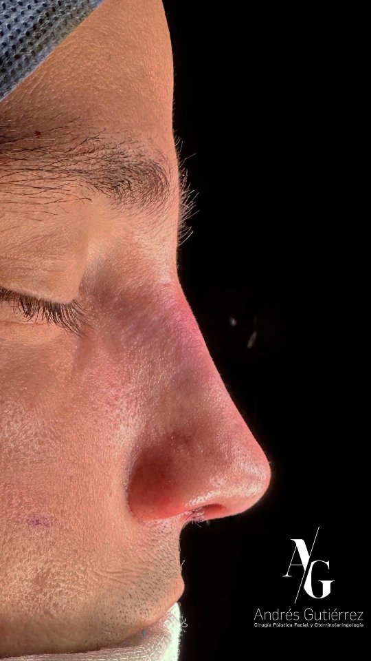Resultado inmediato de Rinoplastia Ultrasónica Estructural primaria. 👨🏻 👃🏼
.
Equipo quirúrgico - Rhinodocs:
@drjaimeospina
@andresgutierrez.dr
.
#rinoplastia #rinoplastiaultrasonica #ultrasonicrhinoplasty
#rhinoplasty #cirugiadenariz #nosejob #cirugiaplasticafacial #facialplasticsurgery #resultadosnaturales #antesydespues #beforeandafter #nosesurgery #rhinoplastybeforeandafter #rhinoplastyspecialist #facialplasticsurgery #topdoc #aesthetic #rinoplasti #estetik #estetikburun #burunestitigi #nose #nasen #newnose #cirugiaplastica #chir urgiaplastica #chirurgieplastique #rhinoplastie #rinoplastica
