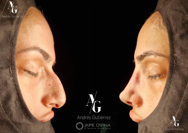 Rinoplastia Ultrasónica Estructural + septoturbinoplastia ♀️, resultado inmediato postQx.
°
°
Laterorrinia derecha y gran giba dorsal. Punta ptósica y poco definida, piel intermedia.
°
°
Equipo quirúrgico: #rhinoteam 🤜🏽🤛🏼
@drjaimeospina CPL
@andresgutierrez.dr ORL
°
°
#rinoplastia #rinoplastiaultrasonica #ultrasonicrhinoplasty
#rhinoplasty #cirugiadenariz #nosejob #cirugiaplasticafacial #facialplasticsurgery #resultadosnaturales #antesydespues #beforeandafter #nosesurgery #rhinoplastybeforeandafter #rhinoplastyspecialist #facialplasticsurgery #topdoc #aesthetic #rinoplasti #estetik #estetikburun #burunestitigi #nose #nasen #newnose #cirugiaplastica #chirurgiaplastica #chirurgieplastique #rhinoplastie #rinoplastica