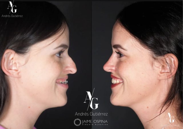 📸 Resultado a los 7 meses ✨
Hoy comparto la evolución de este caso tras una Rinoplastia Ultrasónica Estructural + Radiofrecuencia de Cornetes Inferiores + Septoplastia, combinada con tratamiento de Ortodoncia para lograr una armonía facial más completa y una mejor función respiratoria.
🔹 Antes: desviación septal, alteración valvular interna, laterorrinia y una nariz a tensión que afectaban tanto la estética como la respiración.
🔹 Después de 7 meses: mejoría estructural, válvulas más estables y un perfil más equilibrado. La ortodoncia potenció el resultado final, optimizando la relación entre labios, sonrisa y nariz.
°
°
Equipo quirúrgico:
@drjaimeospina
@andresgutierrez.dr
°
°
#rinoplastia #rinoplastiaultrasonica #ultrasonicrhinoplasty
#rhinoplasty #cirugiadenariz #nosejob #cirugiaplasticafacial #facialplasticsurgery #resultadosnaturales #antesydespues #beforeandafter #nosesurgery #rhinoplastybeforeandafter #rhinoplastyspecialist #topdoc #aesthetic #rinoplasti #estetik #estetikburun #burunestitigi #nose #nasen #newnose #cirugiaplastica #chirurgiaplastica #chirurgieplastique #rhinoplastie #rinoplastica