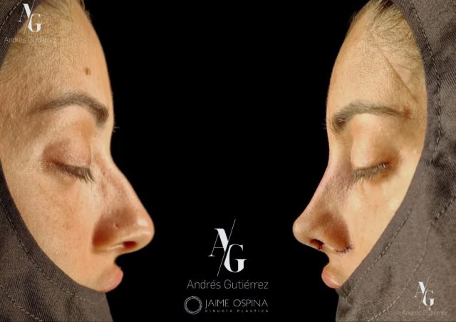 Rinoplastia ultrasónica estructural + septoturbinoplastia.
Resultado postoperatorio inmediato.
Se realizó reducción estructural, refinamiento y desproyección de punta, junto con optimización funcional respiratoria.
La cirugía nasal ideal no enfrenta estética y función. Las integra en un resultado armónico y estable.
Dos especialidades. Un mismo objetivo: forma y función en equilibrio.
👃🏻 Otorrinolaringología @andresgutierrez.dr (ORL)
✨ Cirugía Plástica @drjaimeospina (CPL)
#RinoplastiaUltrasonica #RinoplastiaEstructural #Septoturbinoplastia #CirugiaFacial #RinoplastiaFuncional TrabajoEnEquipo ResultadosNaturales
