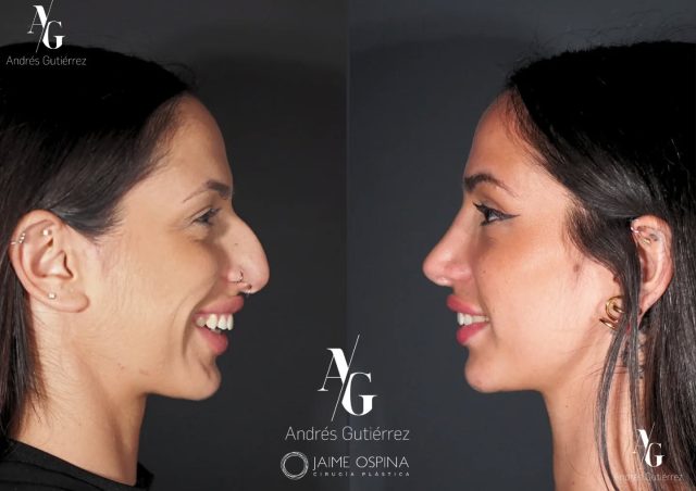 La nariz es el centro del rostro… y cambiarla lo cambia todo. 🤍 Es por eso que la rinoplastia mi cirugía favorita: pequeños cambios, grandes transformaciones. 👃 ✨
Equipo quirúrgico multidisciplinar 🤝🏼
@drjaimeospina
@andresgutierrez.dr
#RinoplastiaUltrasonica #RinoplastiaEstructural #Septoturbinoplastia #CirugiaFacial #RinoplastiaFuncional TrabajoEnEquipo ResultadosNaturales
