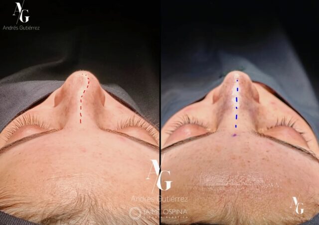 Resultado postquirúrgico inmediato.👃✨
Caso postraumático de alta complejidad. Septo y cartílagos laterales (superiores e inferiores) que presentaban una gran deformidad estructural.
Logramos restaurar el soporte anatómico y la simetría, funcional y estética, en un solo tiempo quirúrgico.
Equipo quirúrgico: #rhinoteam 🤜🏽🤛🏼 @drjaimeospina + @andresgutierrez.dr
#rinoplastia #rinoplastiaultrasonica #cirugiafacial #antesydespues resultadosnaturales nosejob septoplastia