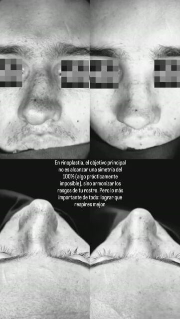 ​En rinoplastia, el objetivo principal no es alcanzar una simetría del 100% (algo prácticamente imposible), sino armonizar los rasgos de tu rostro. Pero lo más importante de todo: lograr que respires mejor.